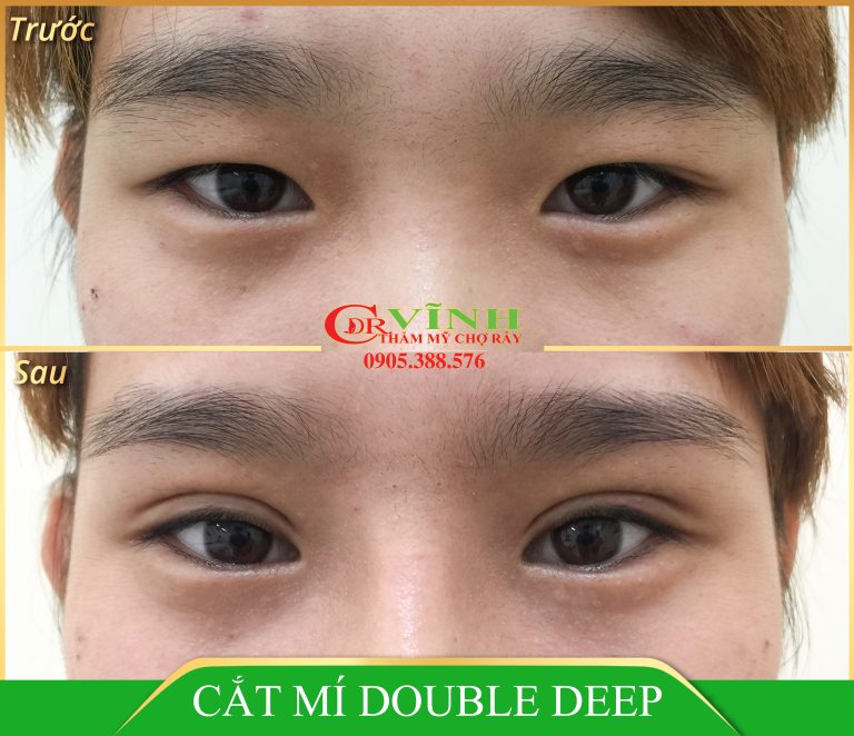 CẮT MẮT DOUBLE DEEP (1)