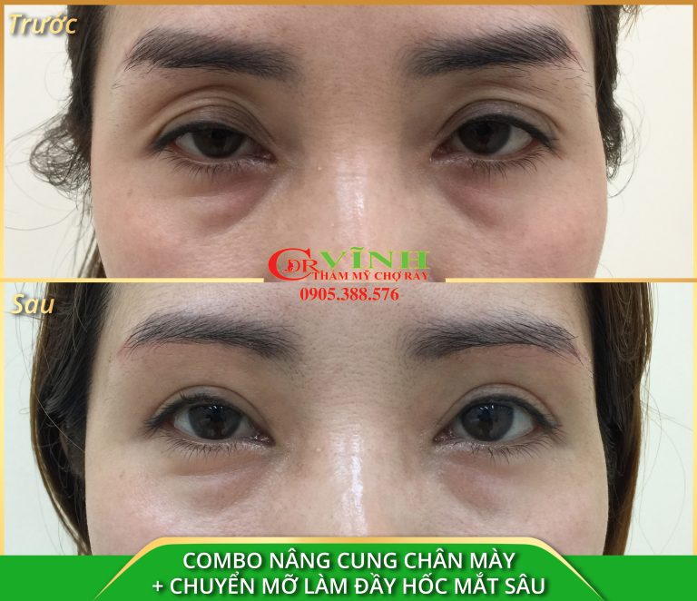 NÂNG CUNG CHÂN MÀY + CHUYỂN MỠ