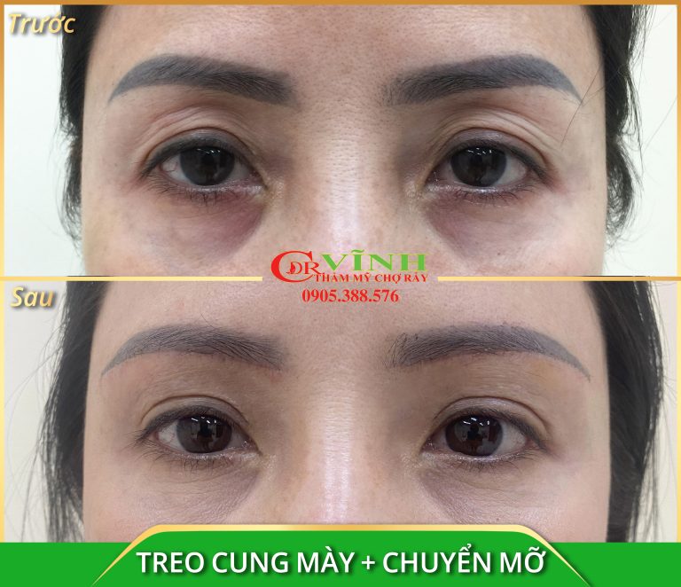 TREO CUNG MÀY + CHUYỂN MỠ