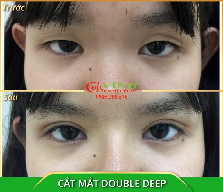 cắt mắt double deep - Copy2
