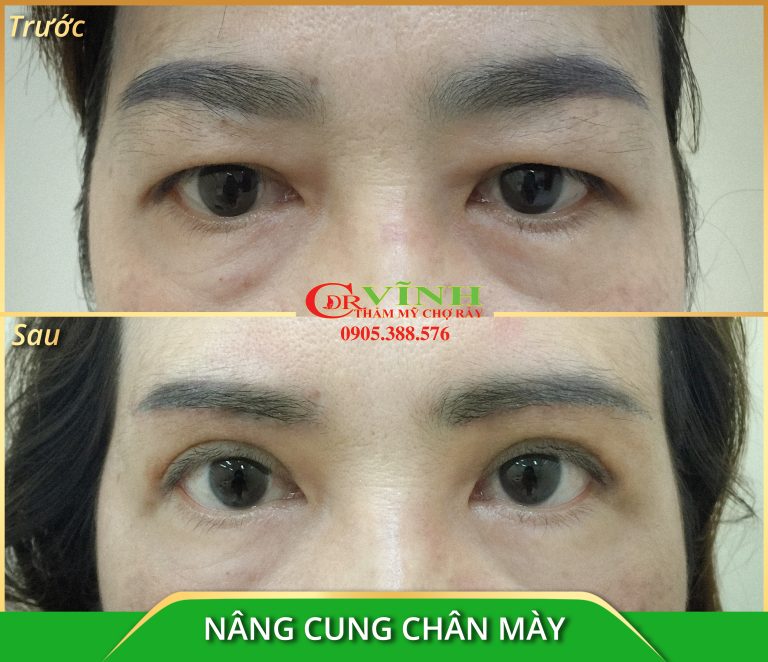 nâng cung chân mày